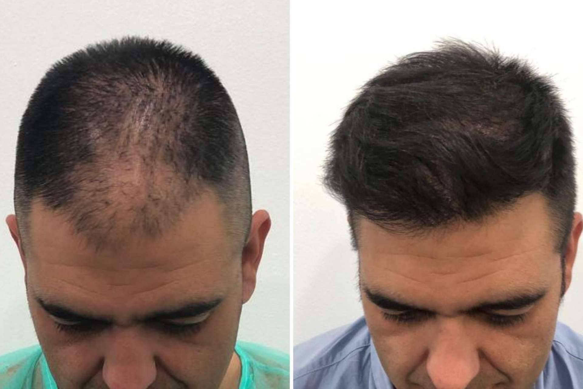 Injerto capilar en Injermur con la exclusiva técnica META FUE 3 Dual, ¿cuáles son sus ventajas y cómo funciona?