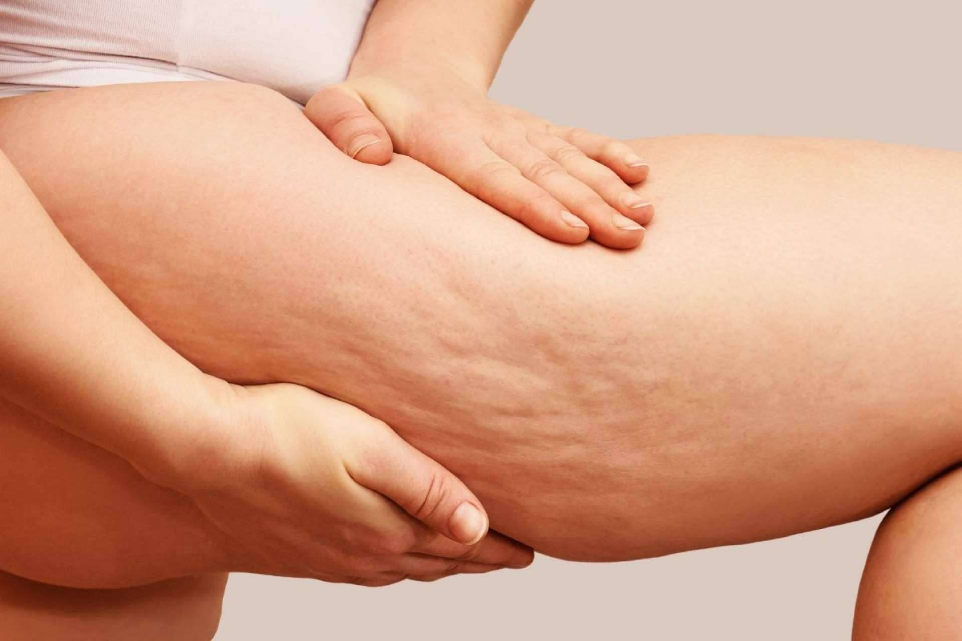 ¿Cuáles son las posibles causas y soluciones de la celulitis?