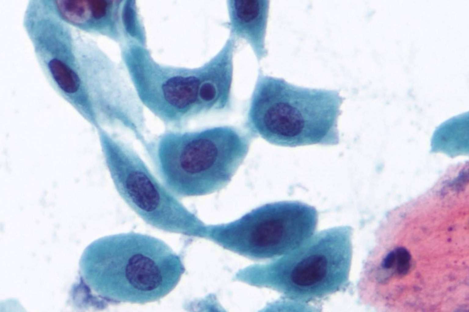 CITOMOL impulsa la detección del virus del papiloma humano en varones