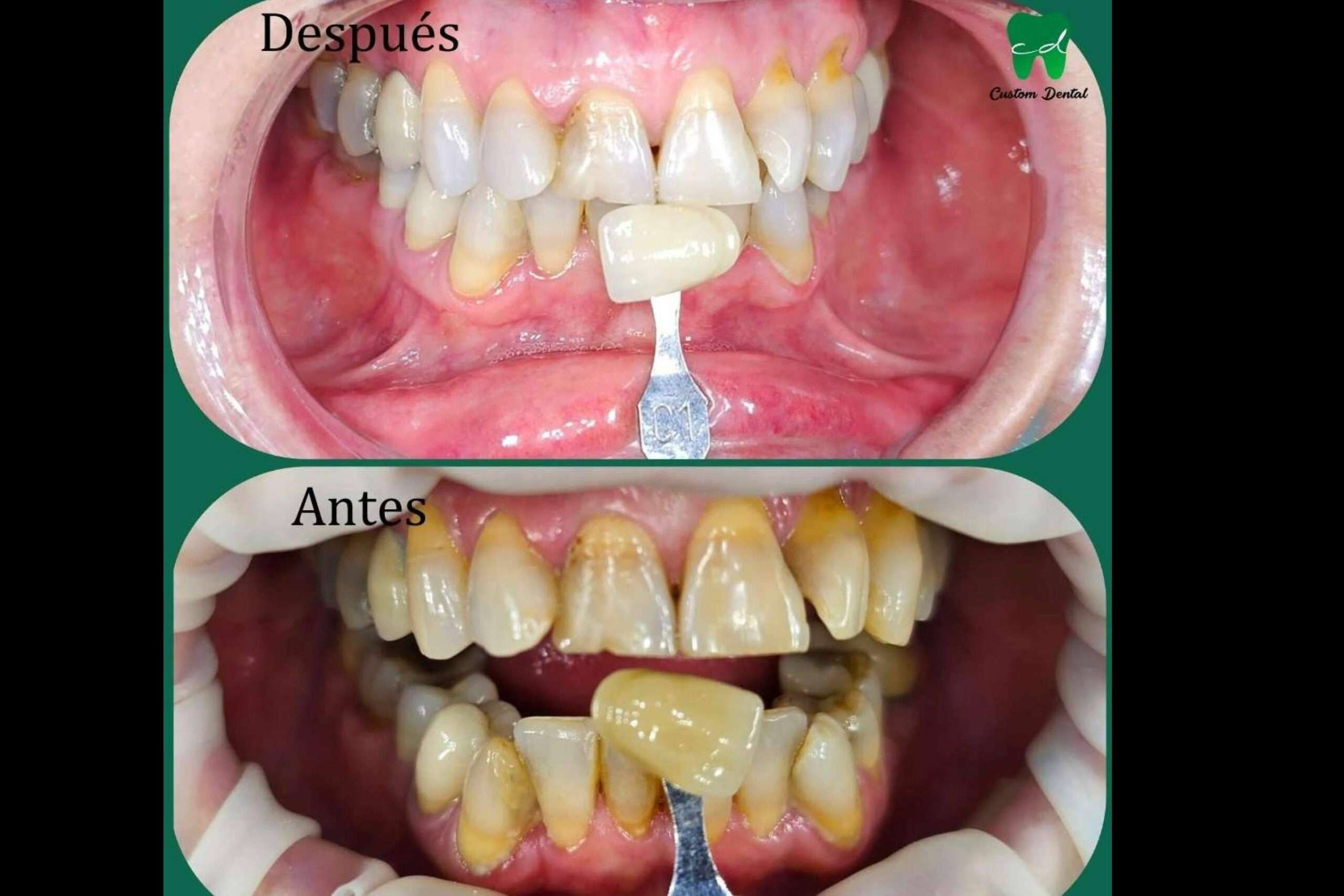 La importancia de una sonrisa radiante; Blanqueamiento dental en dos citas