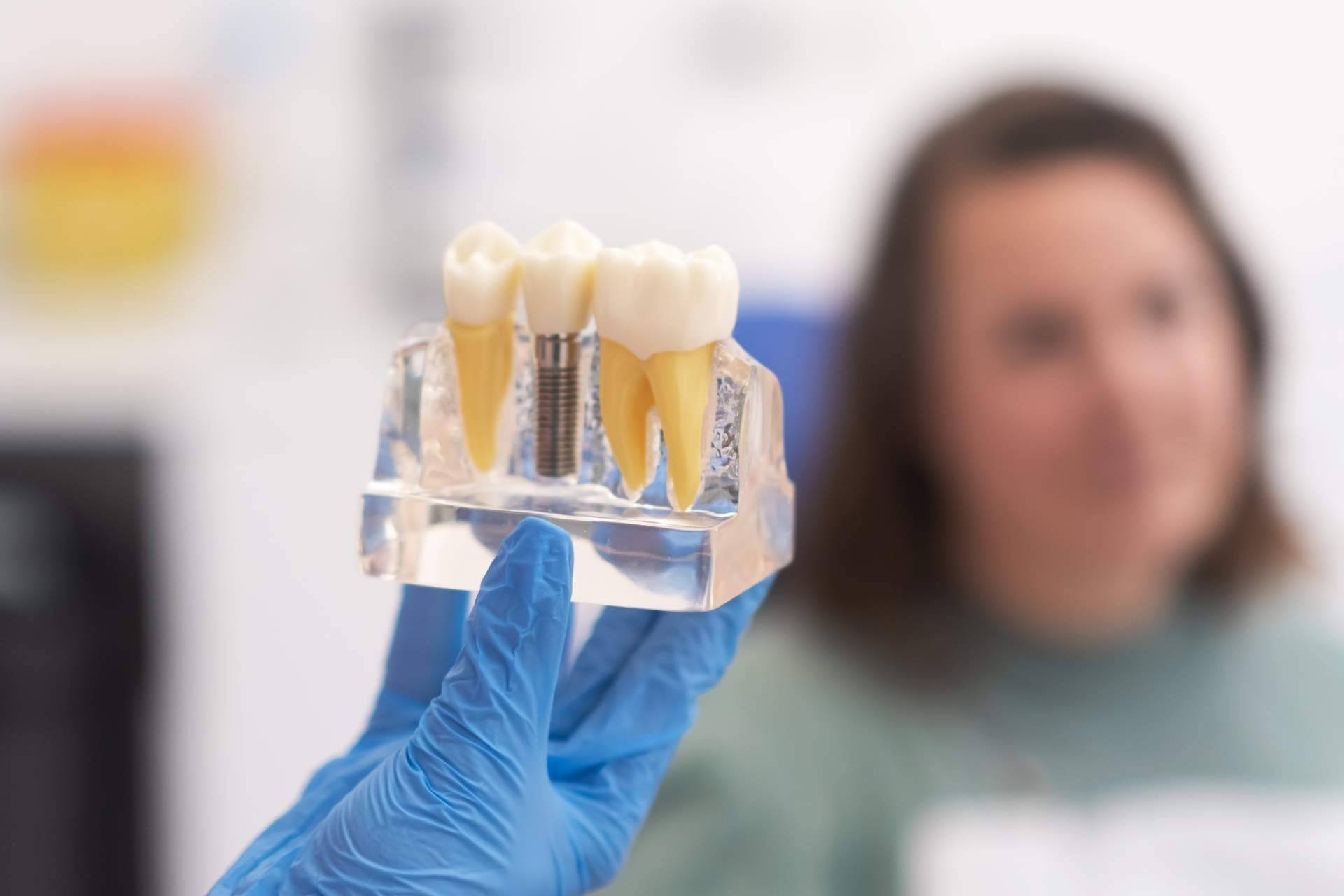 Los implantes dentales de carga inmediata, una alternativa rápida y segura para recuperar la sonrisa