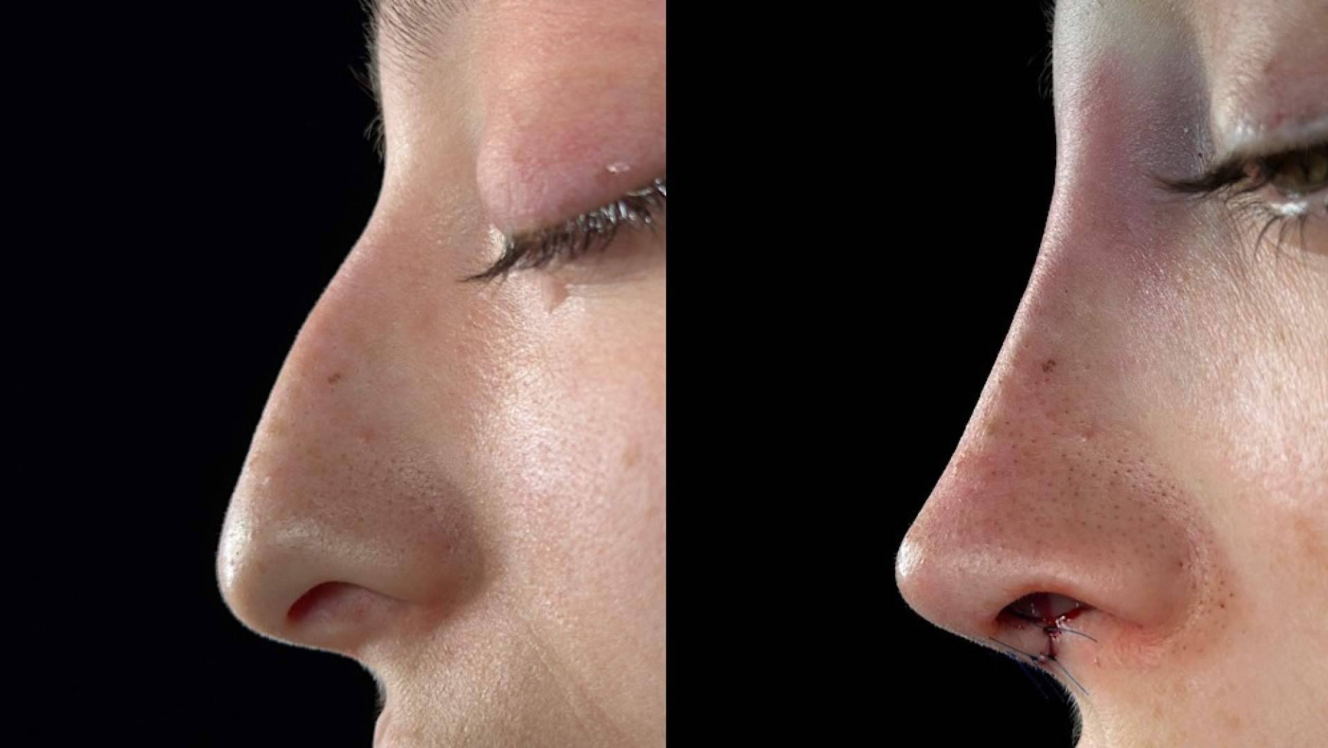 La identidad facial como eje de la rinoplastia, la propuesta diferenciadora del Dr. Alfonso Campos