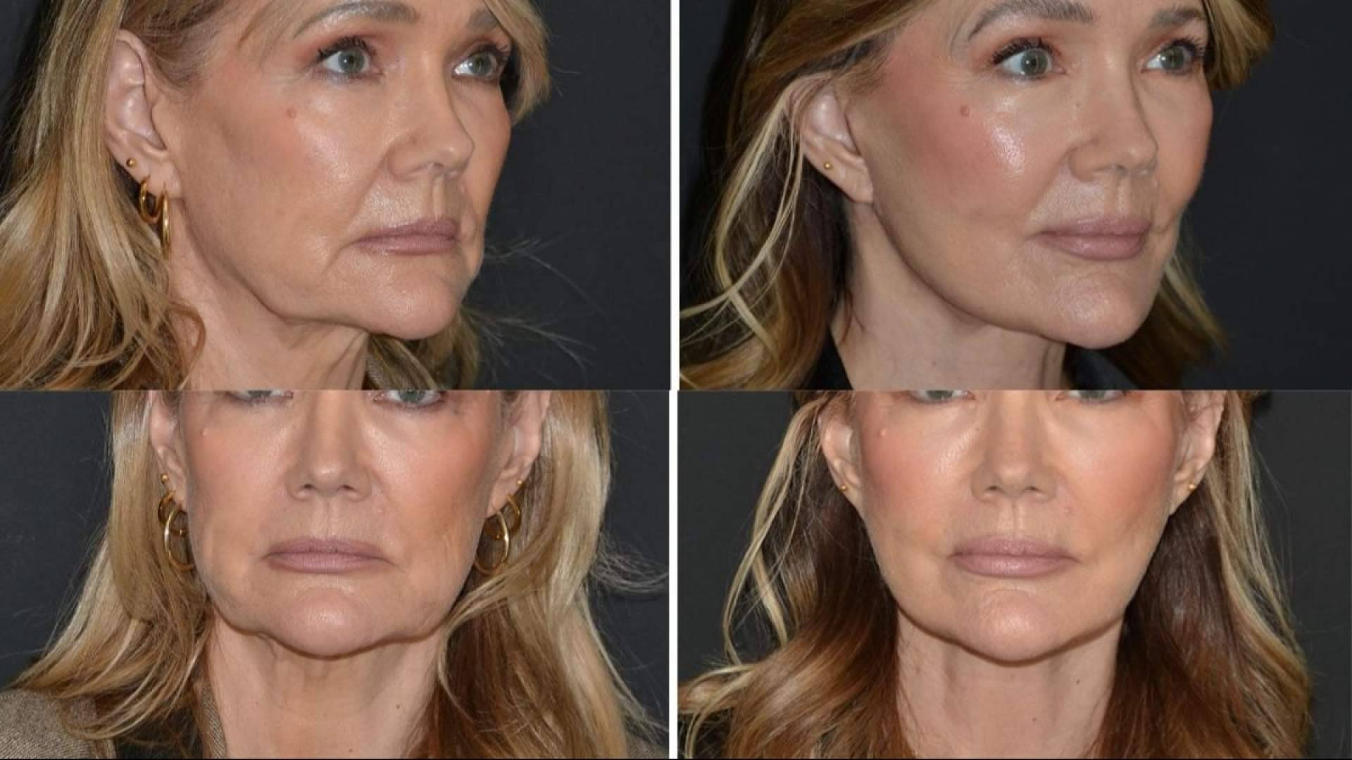¿Por qué el Deep Plane Facelift está redefiniendo el rejuvenecimiento facial en 2026?